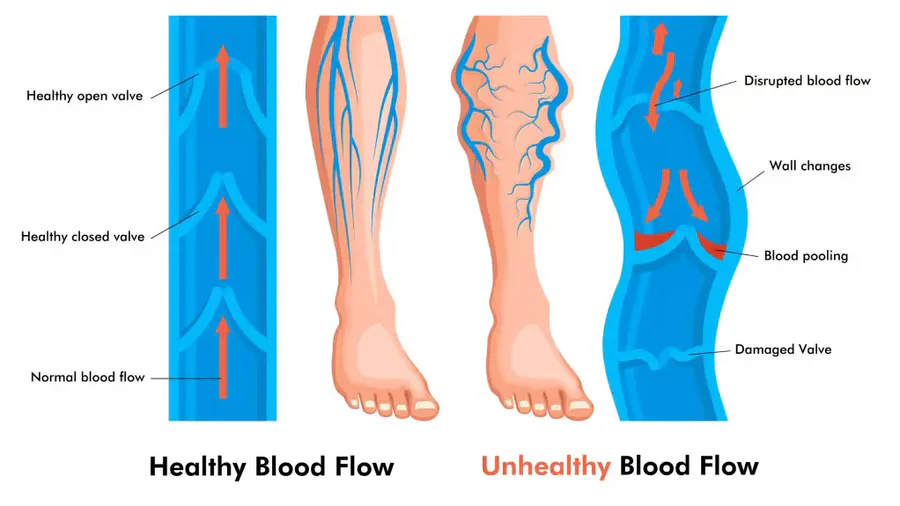 The Science of Gradual Compression – How It Works
